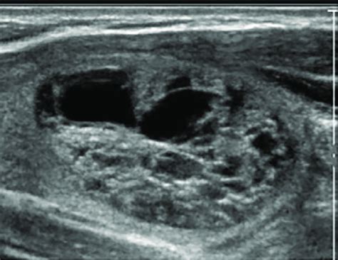 Thyroid Us Showing A Cystic Sponorm Nodule Compatible With A Benign