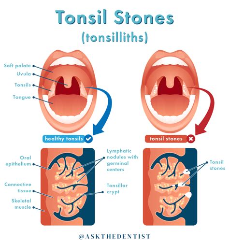 Tonsil Stones Symptoms Causes And How To Remove Ask The Dentist