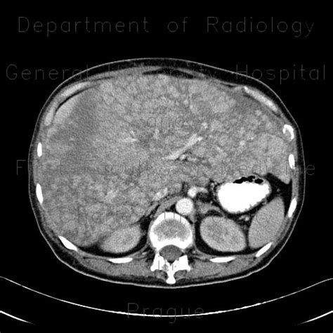 Radiology Case Multiple Myeloma Venooclusive Disease Of Liver