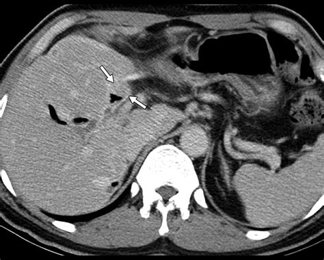 Cyst Forming Intraductal Papillary Neoplasm Of The Bile Ducts