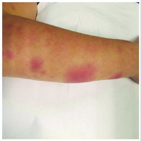 Erythema Nodosum With Bilateral Eruption Of Painful Subcutaneous