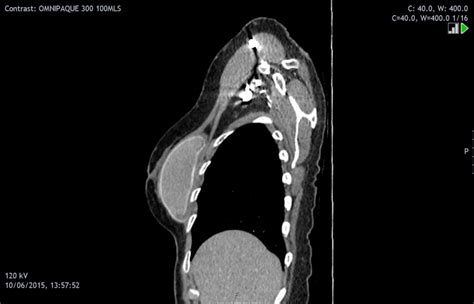 Breast Implant Rupture Pacs