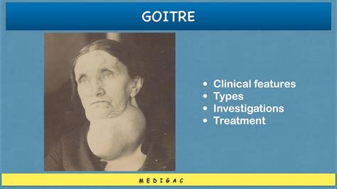 Goitre Clinical Features Ethologycauses Types Investigations