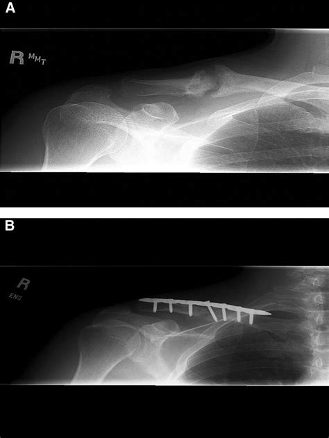 Treatment Of Clavicle Fractures Current Concepts Review Journal Of