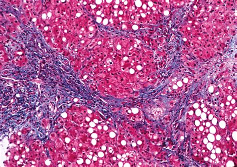 Cirrhosis of liver is a chronic condition in which healthy liver tissue is replaced by scarred tissue, preventing the liver from. Diagnosis of cirrhosis - new approaches to liver disease ...
