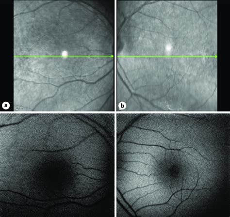 Infrared Fundus Imaging And Fundus Autofluorescence Imaging With