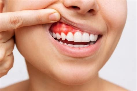 4 Effective Tips To Prevent Gum Disease The Source Full