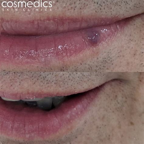 Laser Venous Lake Treatment Lip Blood Blister Cosmedics Skin Clinics