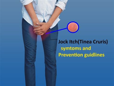 what does jock itch tinea cruris look and smell like how it is treated