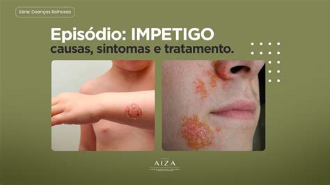 Doenças Bolhosas Impetigo Causas Sintomas E Tratamento Youtube