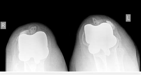 X Ray With Skyline View Of Both Knees Showing Component Loosening
