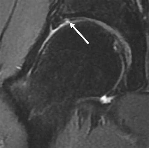 Fig 59 Coronal T2 Fat Suppressed Mr Image Musculoskeletal