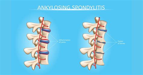 Chiropractic Treatment For Ankylosing Spondylitis Dutchess Braincore