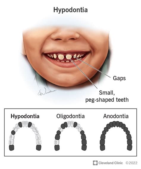 Hypodontia Missing Teeth Causes And Treatment