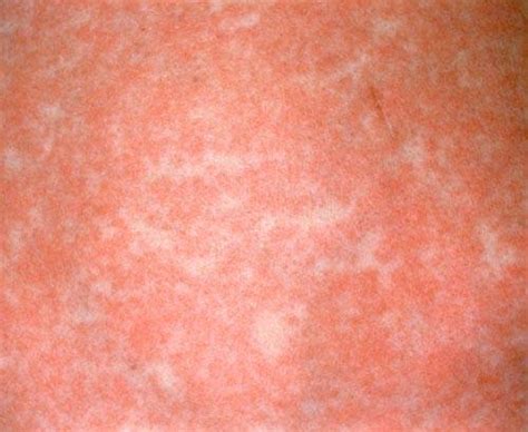 Measles Pictures Enetmd