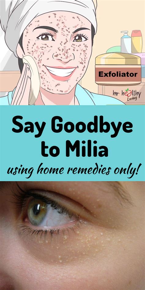 How To Get Rid Of Milia A Guide To Removal