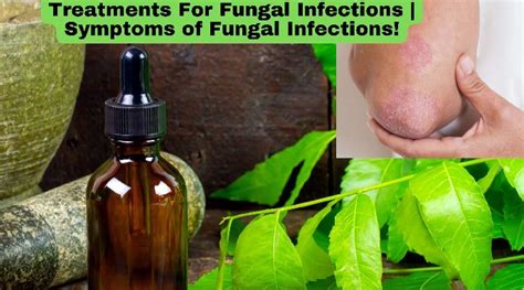 Treatments For Fungal Infections Symptoms Of Fungal Infections