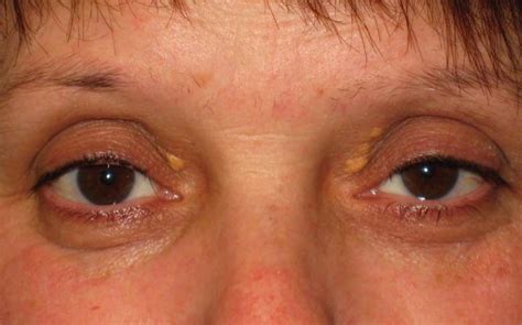 White Cholesterol Spots On Eyelids Wholesale Offers Save 51 Jlcatj