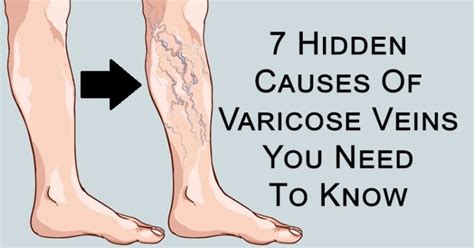 Incredibly Simple Ways To Fight Varicose And Spider Veins David
