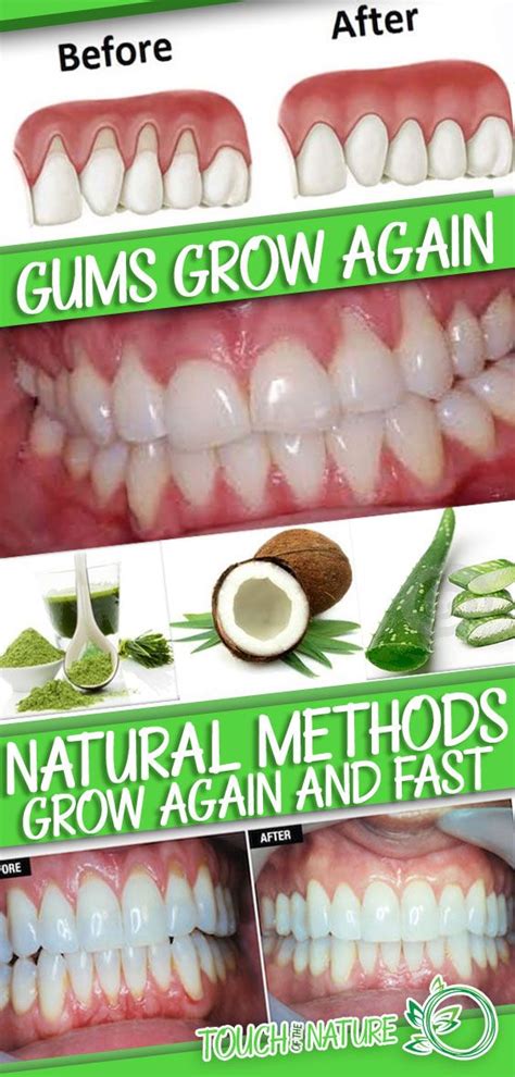 Make Receding Gums Grow Again And Fast With These Natural Methods