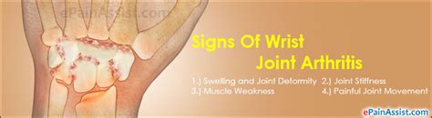 Wrist Joint Arthritissymptomscausestreatment Medications Nsaids Pt