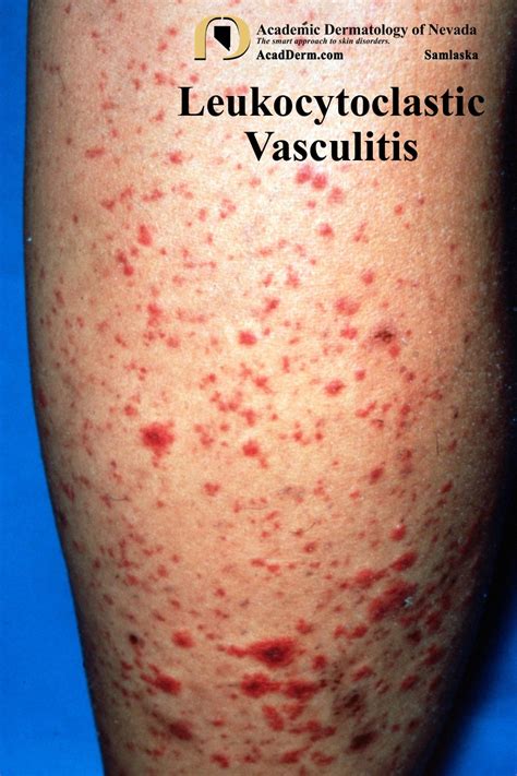 Leukocytoclastic Vasculitis Small Vessel Vasculitis Academic