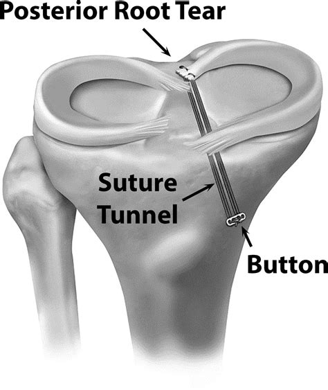 References In Posterior Meniscal Root Repair The Transtibial Double Tunnel Pullout Technique