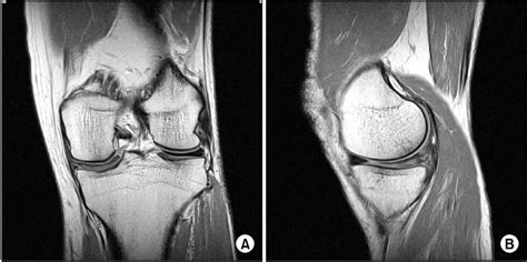 Left Knee Magnetic Resonance Imag­ Ing Showing A Complete Discoid