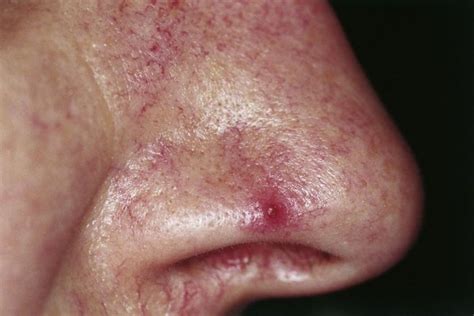 Bleeding Pore On Nose 11 Possible Causes And Treatments Skin Care Geeks