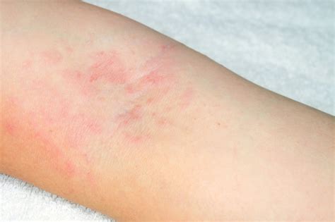Allergy To Red Rash On The Arms On White Background Photo Premium