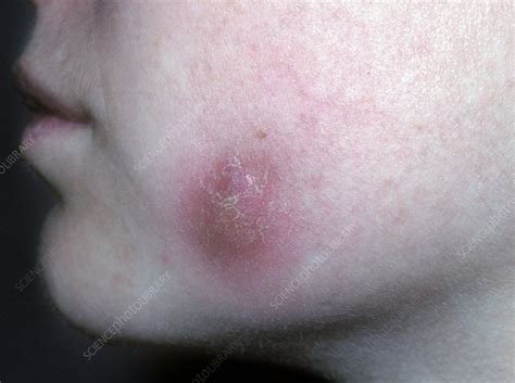 Cellulitis Of The Cheek Stock Image C0071655 Science Photo Library