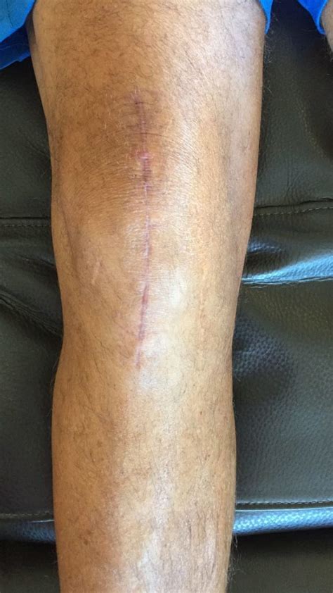 1 Year After Knee Replacement Surgery 12 Months Of Healing