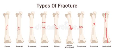 Types Of Bone Fractures Body Injury Partial Or Complete Break Stock