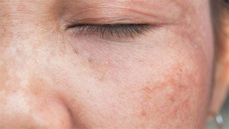 Melasma Como Tratar E Prevenir As Manchas Na Pele Creamy Skincare