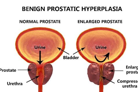 Frequently Asked Questions About Benign Prostate Enlargement Health Detox Vitamins