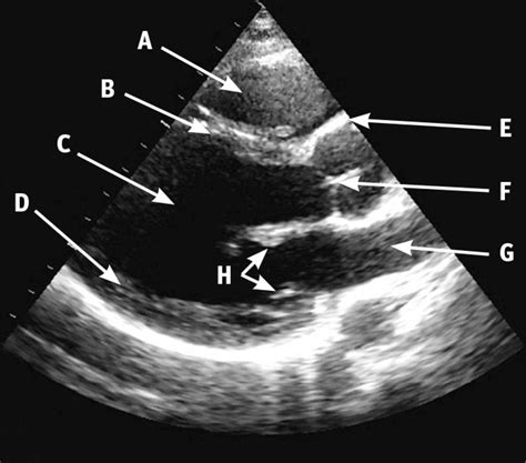Transthoracic Echocardiogram In A Parasternal Long Axis Window The Bmj