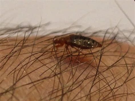 Bed Bugs In Hair Symptoms Treatment Pictures Eggs And More
