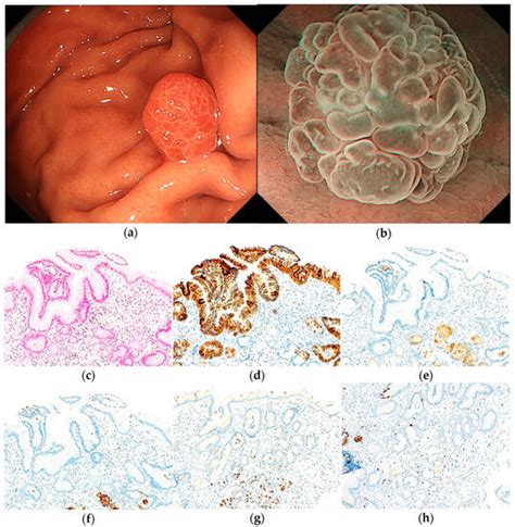 Jcm Special Issue Gastric Cancer Diagnosis Treatment And Prevention