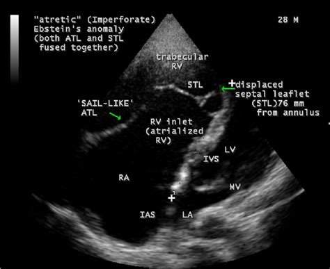 Apical View Showing The Redundant Sail Like Anterior Tricuspid
