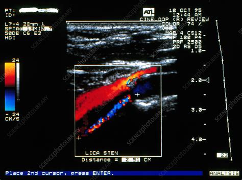 Doppler Ultrasound Scan Of Carotid Artery Stenosis Stock Image M175