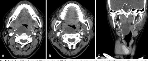 Figure 2 From A Case Of Second Branchial Cyst In Retropharyngeal Space