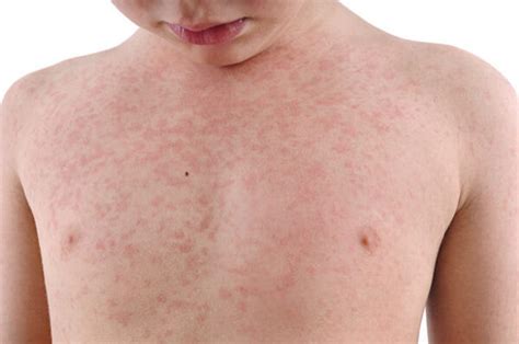 What Is My Childs Rash How To Identify 10 Rashes And Tell If Theyre