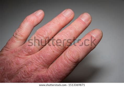 Hand Psoriasis Patient Closeup Psoriatic Arthritis Stock Photo