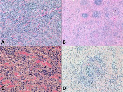 Histopathological Features Of Igg 4 Related Disease A Storiform