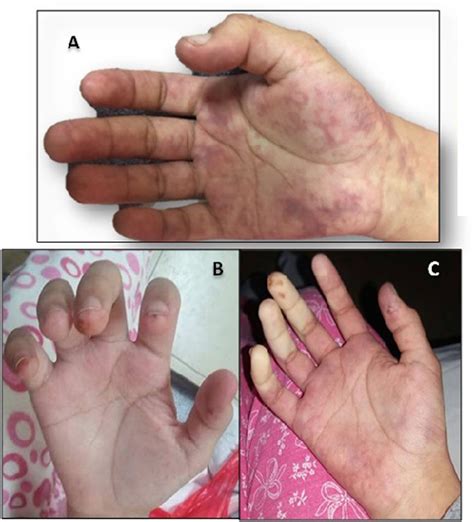 Right Hand A Livedo Reticularis B Trophic Changes In Fingertips
