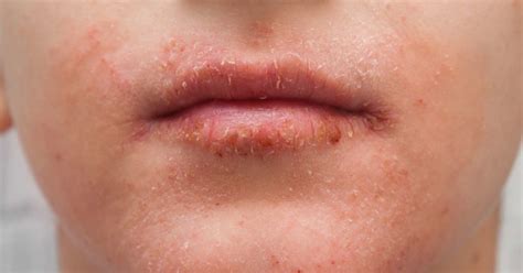 How To Reduce Redness Around Lips Considerationhire Doralutz