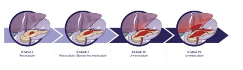 How Is The Extent Of Pancreatic Cancer Assessed Staging