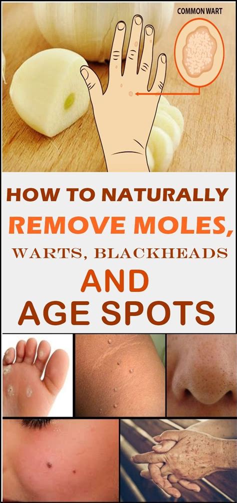 how to naturally remove moles warts blackheads and age spots agespotsonarms warts what