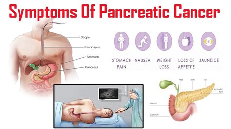 Pancreatic Cancer Causes Risk Factors Symptoms Prevention