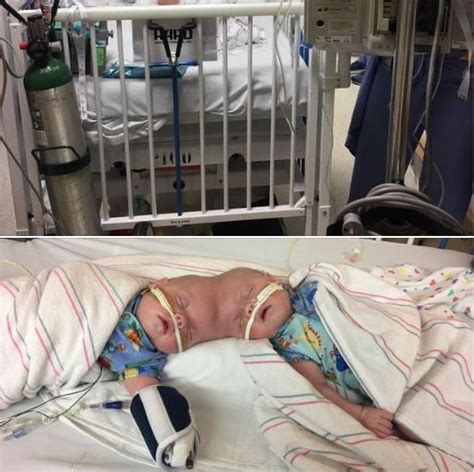 Conjoined Twins Abby And Erin Delaney Inside Their Remarkable Story